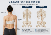 스마트폰·잘못된 자세 영향… 젊은 층 척추측만증 증가